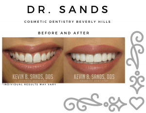 Before and after of a cosmetic dentistry patient in Beverly Hills