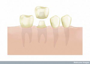 Diagram of teeth with a crown
