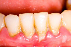 Tartar buildup on front lower teeth