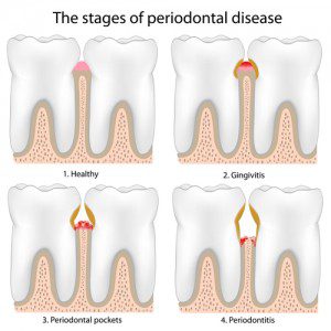 Drawing of teeth with 4 stages of periodontal disease, each in a separate corner: healthy, gingivitis, periodontal pockets, and periodontitis