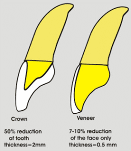 Comparison of porcelain veneers and caps 