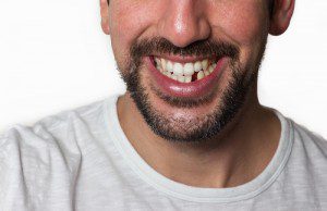 Close up of a man's lower face and shoulders, smiling with a missing lower incisor on a white background 