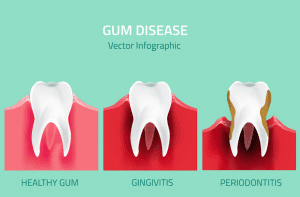 Teeth infographic. Gum disease stages