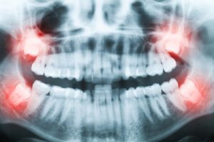 Closeup of x ray image of teeth and mouth with all four molars vertically impacted