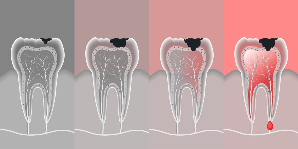 process teeth problem with vector-img-blog