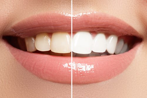 perfect smile before and after bleaching. dental care and whitening teeth-img-blog