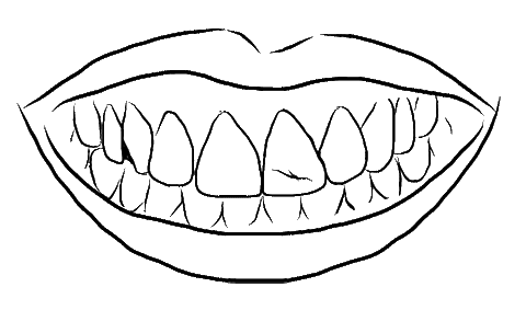 Drawing of damaged teeth