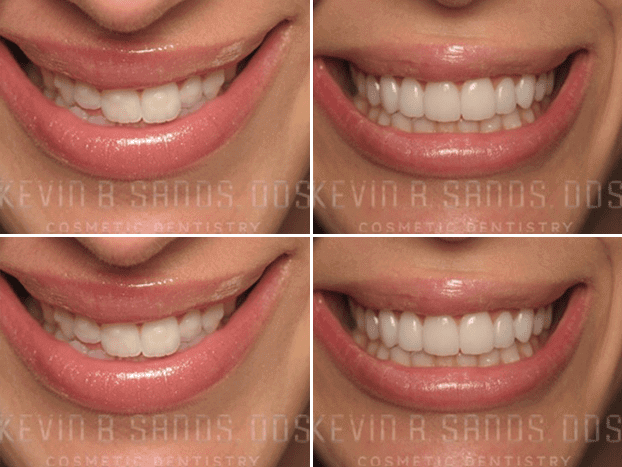 Porcelain Veneers Actual Patient Results