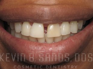 Dental Bonding in Beverly Hills, CA Before Image 3