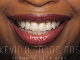 Dental Bonding in Beverly Hills, CA After Image 3