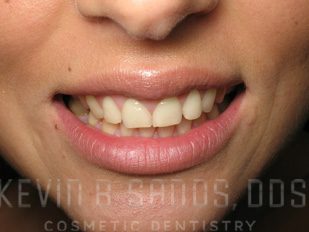 Periodontal Care in Beverly Hills, CA Before Image 2