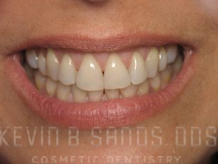 Gum Contouring in Beverly Hills, CA Before Image 1