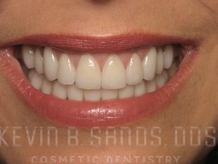 Gum Contouring in Beverly Hills, CA After Image 1