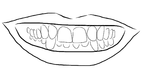 Drawing of an overbite