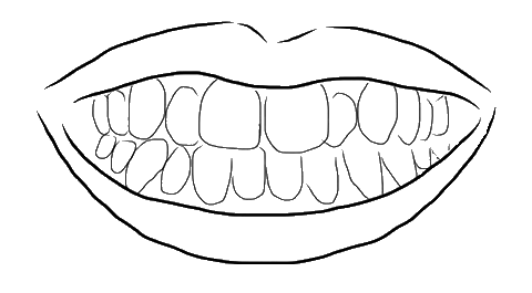 Drawing of an overcrowding smile