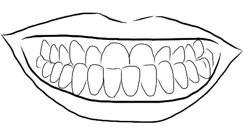 Drawing of an underbite