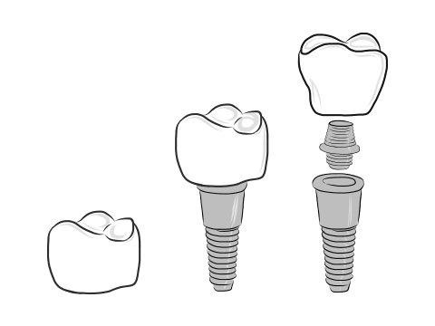 Diagram of a replacement tooth