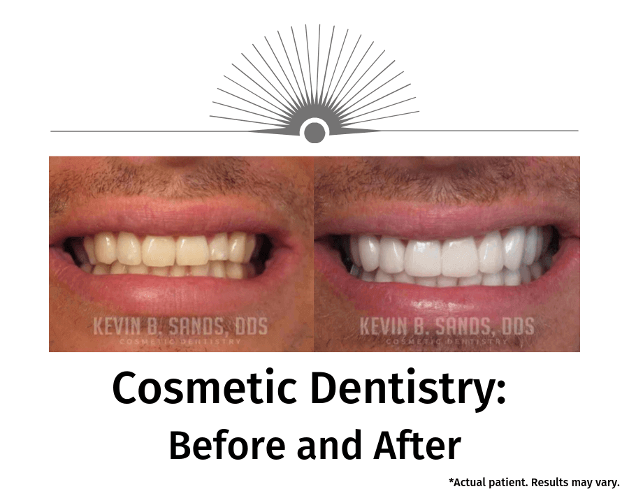 A before and after image of a patient who had work performed on their teeth. There are different options to improve the aesthetic of your teeth.