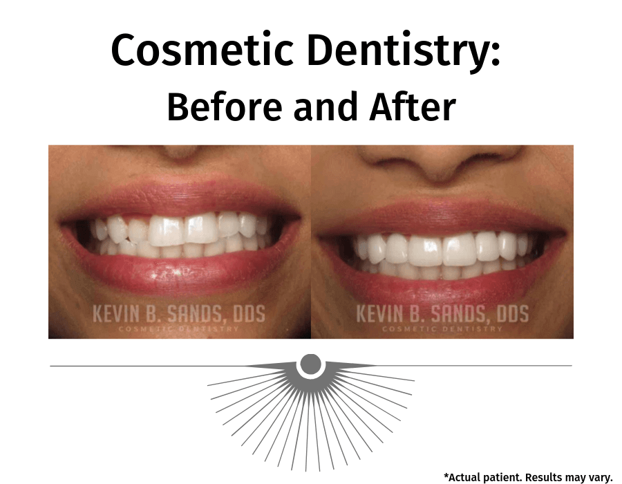 A before and after image of a patient who had work performed on their teeth. There are different options to improve the aesthetic of your teeth.