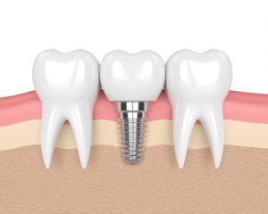 3D image of dental implant