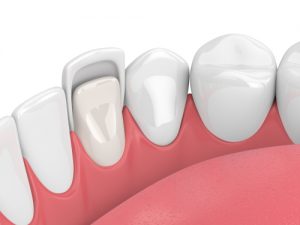 Artist Rendering of Dental Veneer Fitting