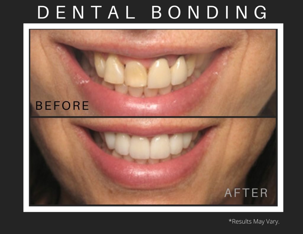 A before and after image of a patient who went through a dental bonding procedure to create a naturally beautiful smile.