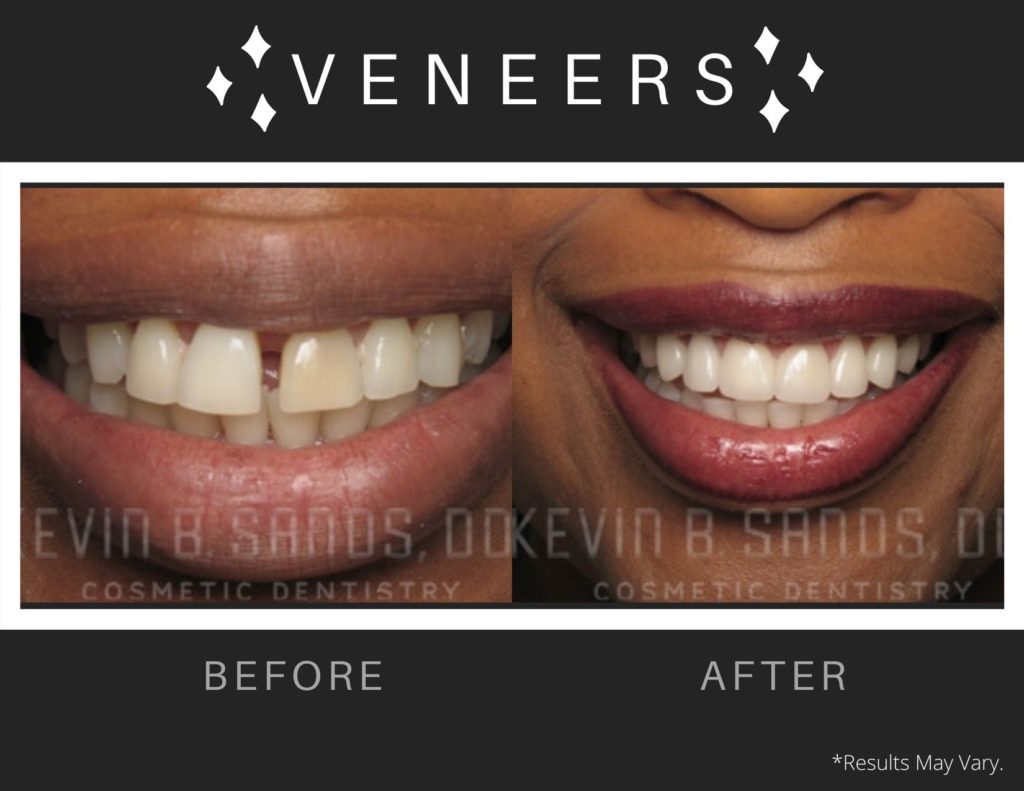 A before and after image of a patient who used veneers to create a healthy, straight smile.