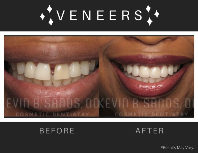 Filling the Gaps Veneers, Implants and Dental Bonding Dr. Kevin Sands