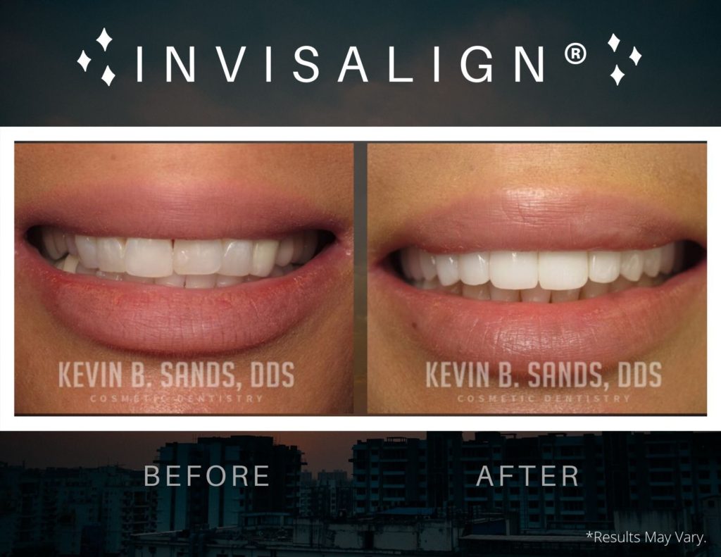 before-and-after-invisalign-dks-p57-a-dks-p57-b