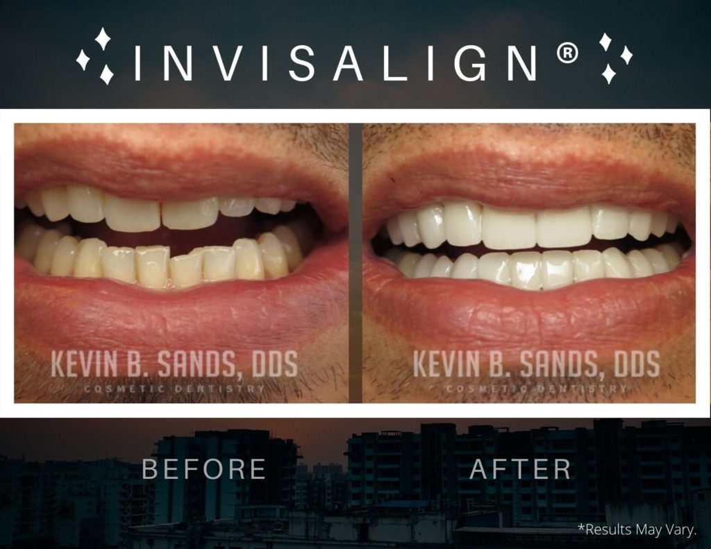 before-and-after-invisalign-dks-p58-a-dks-p58-b