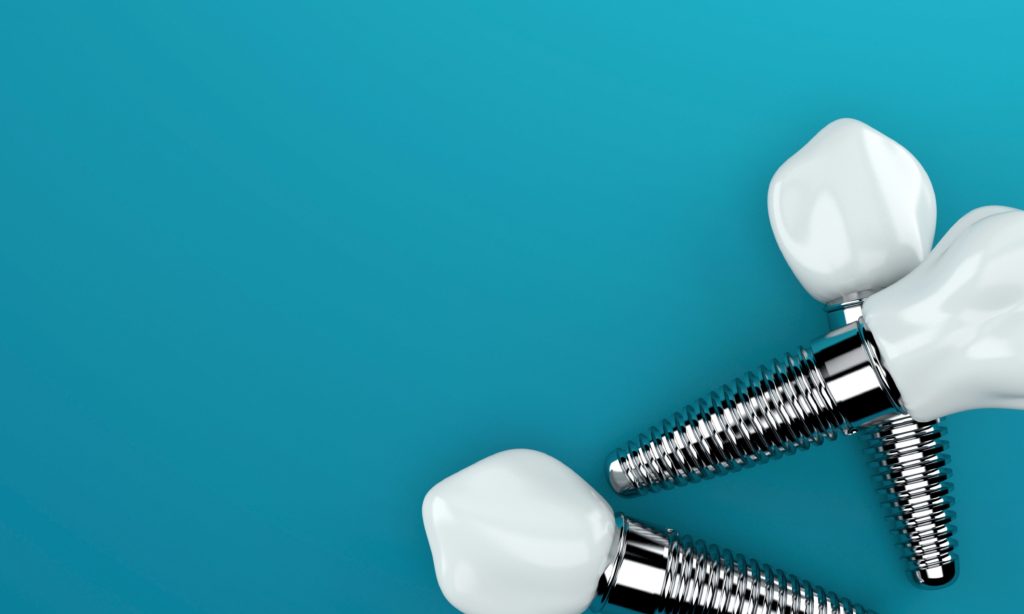 anatomy of the dental implants including the root and the prosthetic tooth