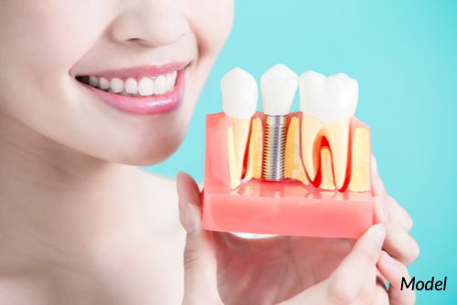 Dental implants offer solid support for replacing broken or missing teeth, restoring functionality and appearance for a beautiful, healthy smile.