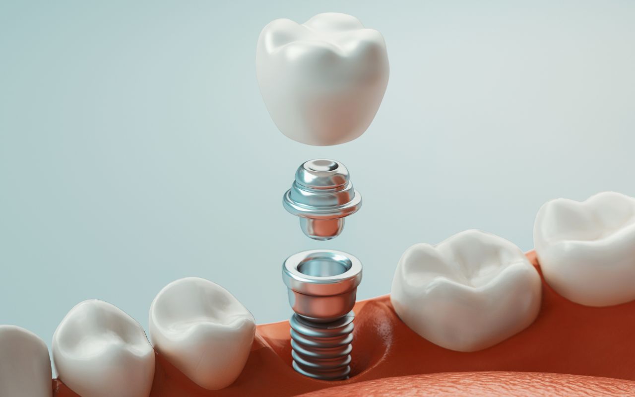 Dental implant