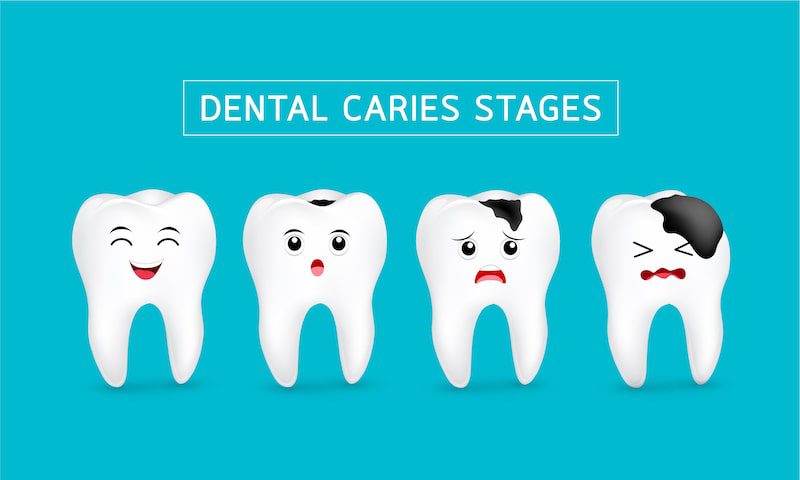 Illustration demonstrating the stages of a cavity