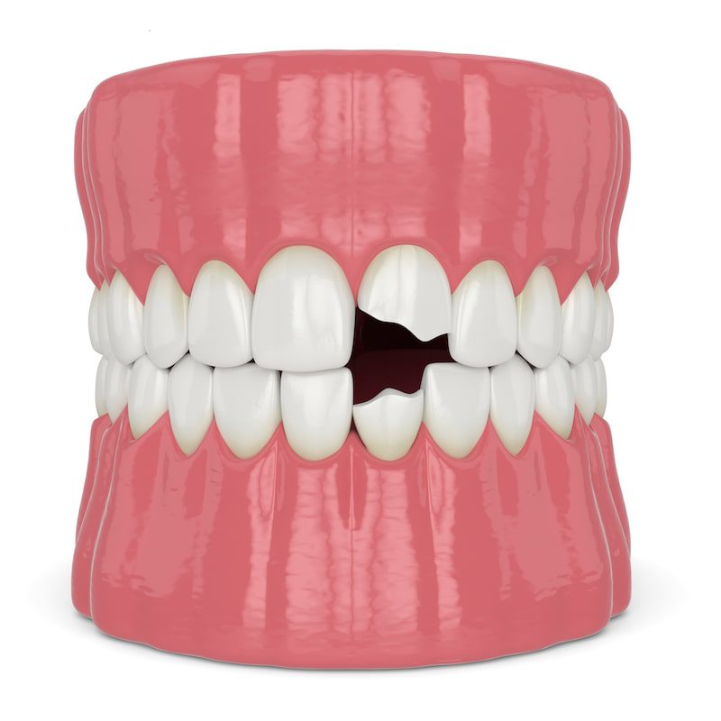 illustration of two broken teeth.