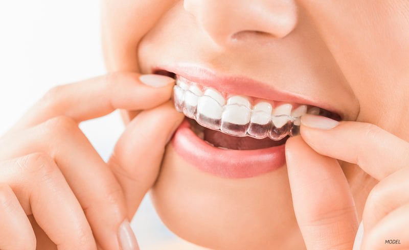 Woman’s mouth and teeth with clear orthodontic aligners as she pulls them out with her fingers.