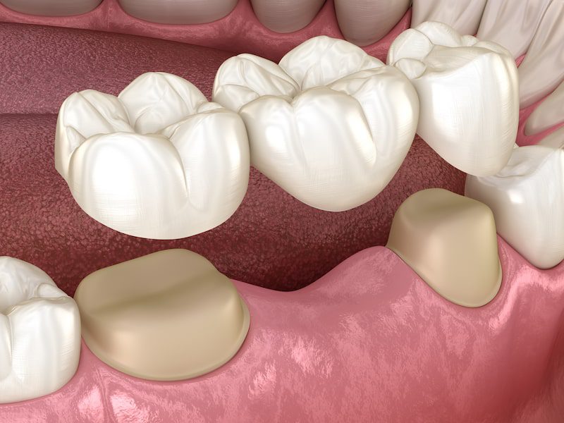 Computer rendering of a dental bridge.