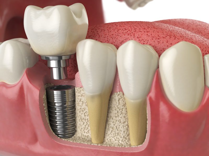 Computer Illustration rendering of a dental implant.
