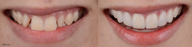 Before and after cosmetic dental treatment.