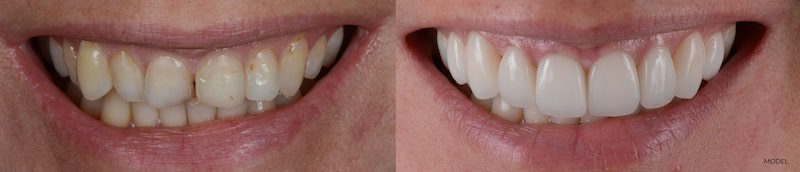 Before and after photo of a smile makeover.