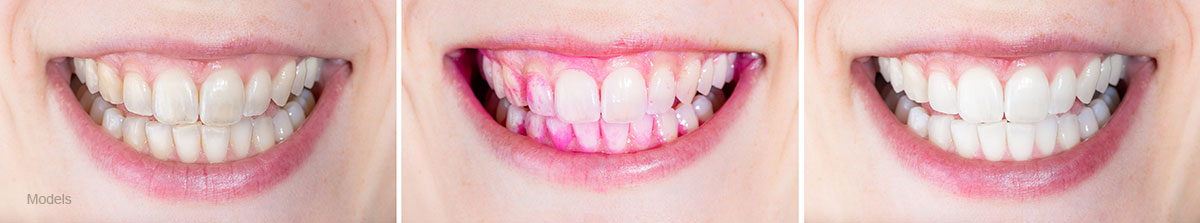 Three images of teeth before and after dental deep cleaning.