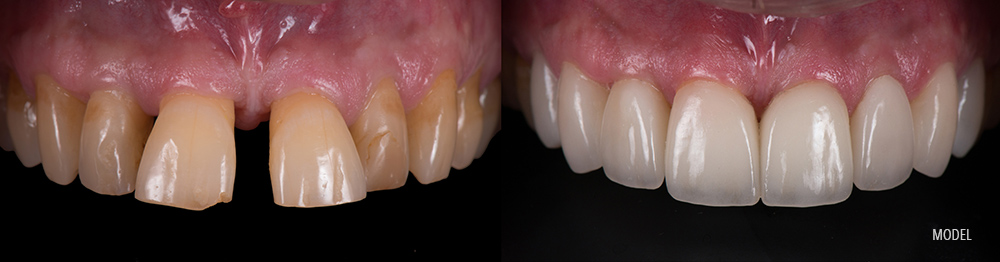 Photo of damaged and discolored teeth before and after a smile makeover.