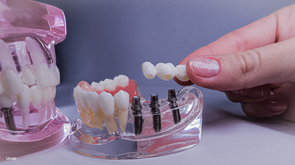 Arch dental implant