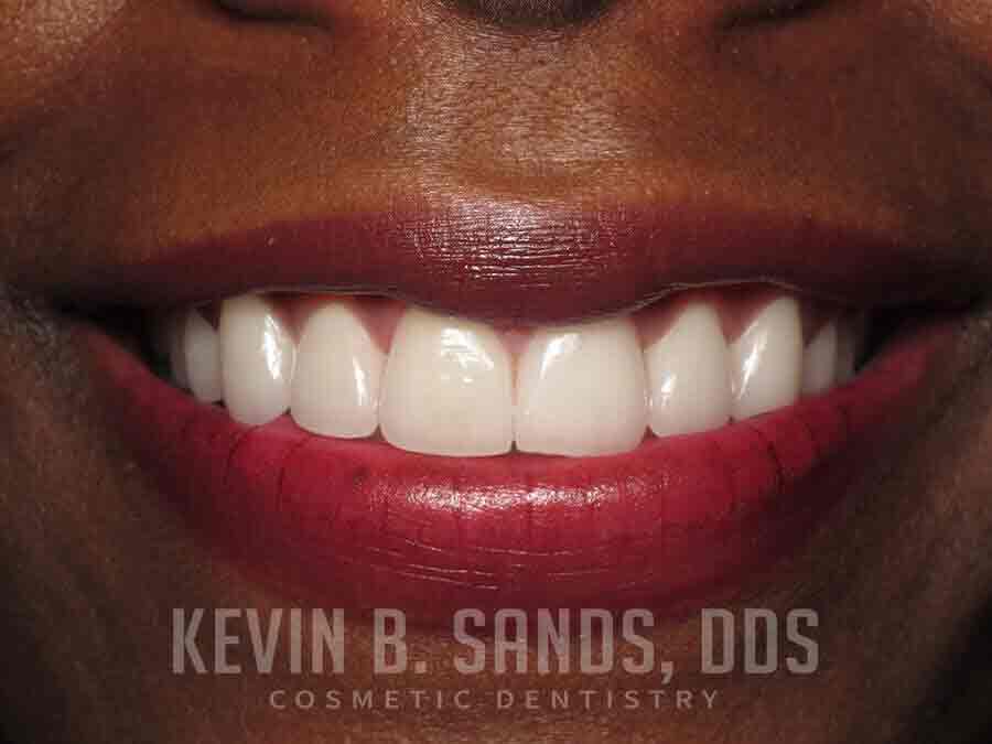 Sedation Dentistry in Beverly Hills, CA After Image 4